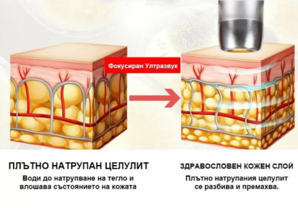 Ανύψωση και αναζωογόνηση δέρματος - συσκευή V-Max HIFU