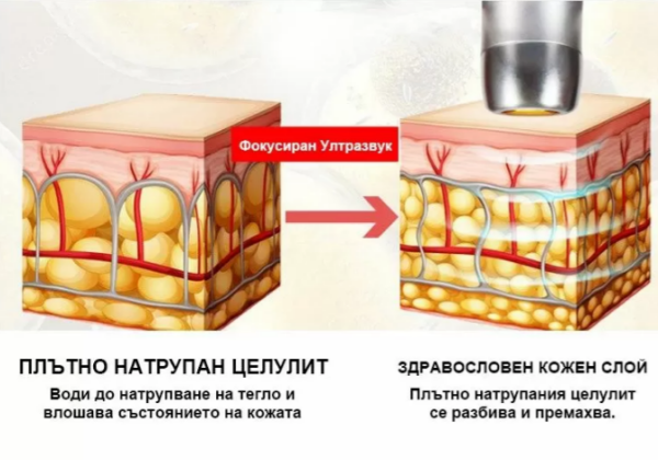 Skin lifting and rejuvenation - V-Max HIFU device